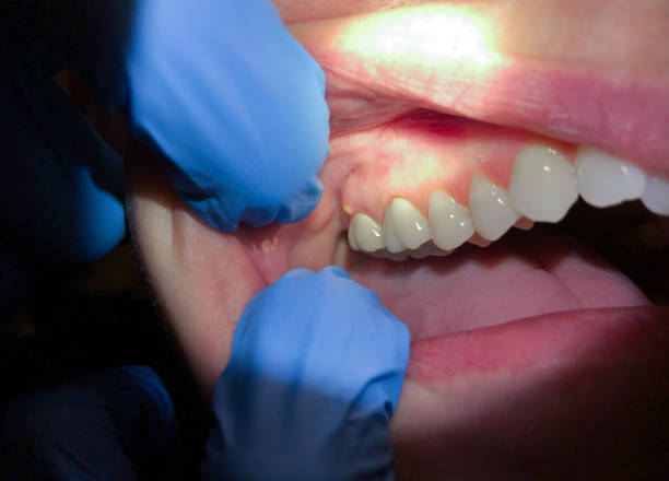 Best Tooth Infection Emergency Dentist  in Schwenksville, PA